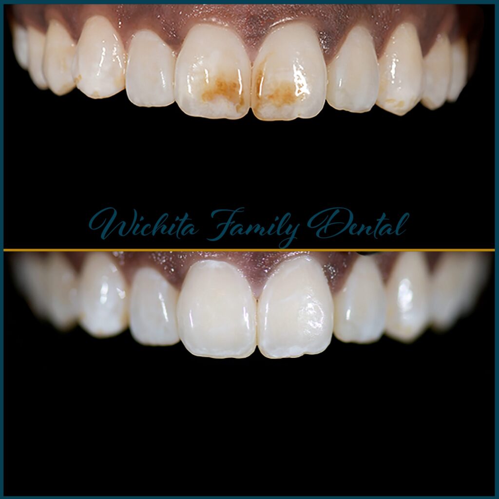 Before and after dental treatment at Derby Dental Care, showcasing significant oral health improvements.