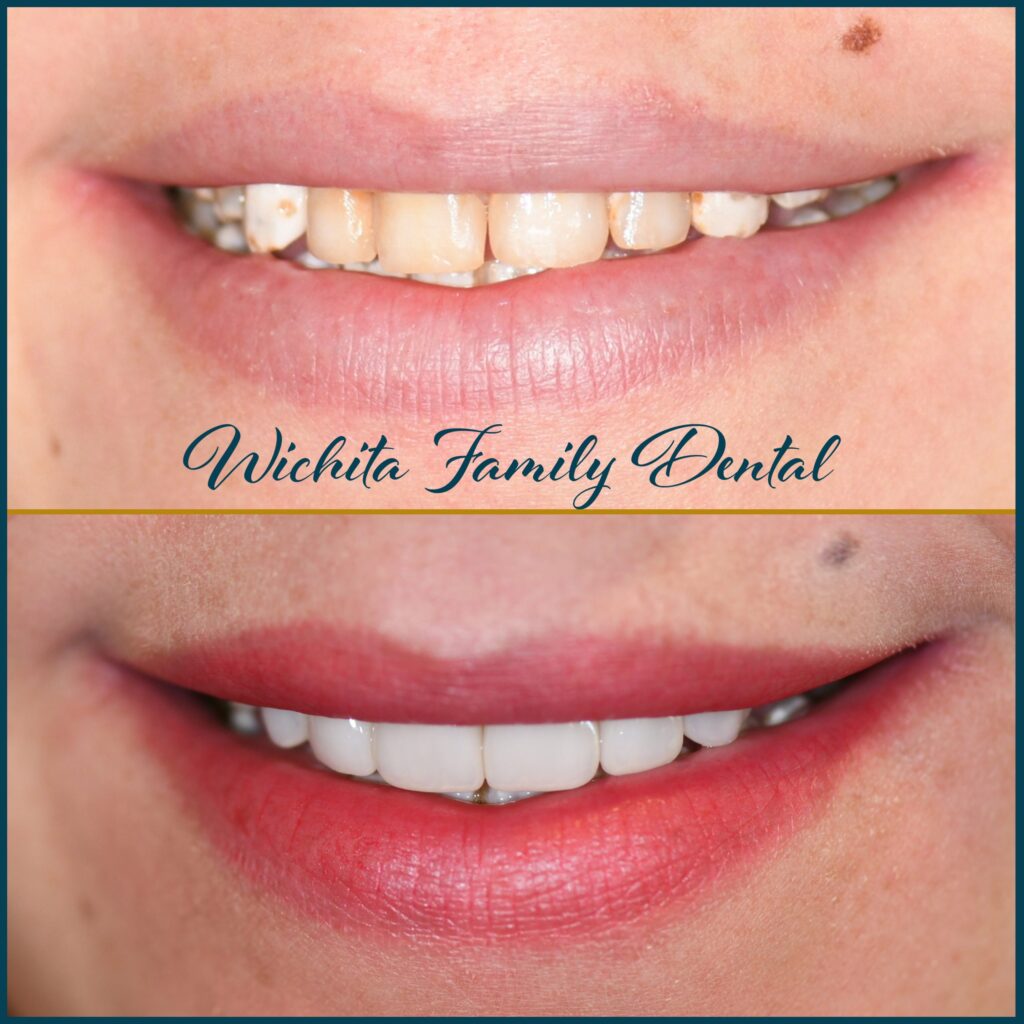 Smile transformation at Derby Dental Care in Derby, KS, with visible enhancements in before and after photos.