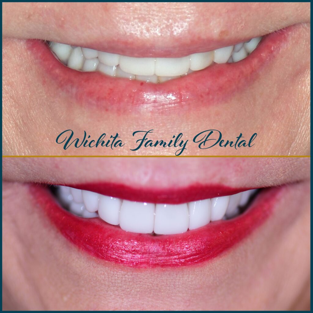 Oral health rehabilitation before and after images at Derby Dental Care, showing comprehensive dental corrections.