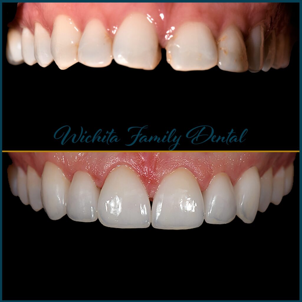 Cosmetic dental improvements at Derby Dental Care, evident in before and after snapshots, enhancing smile aesthetics.