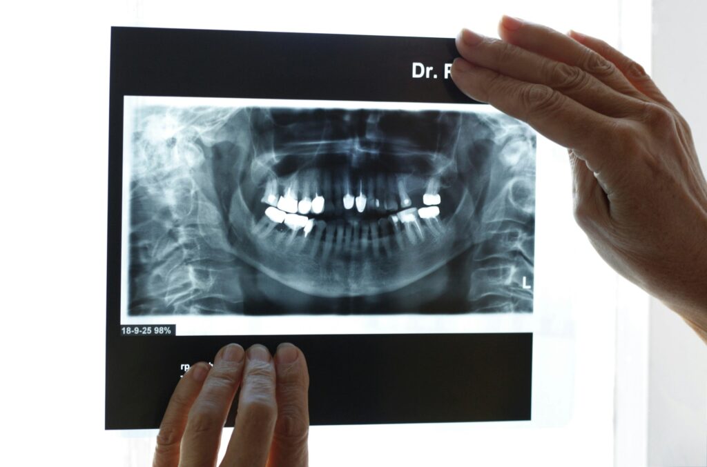 X-ray image showing detailed tooth structure, used for diagnostic purposes at Derby Dental Care.