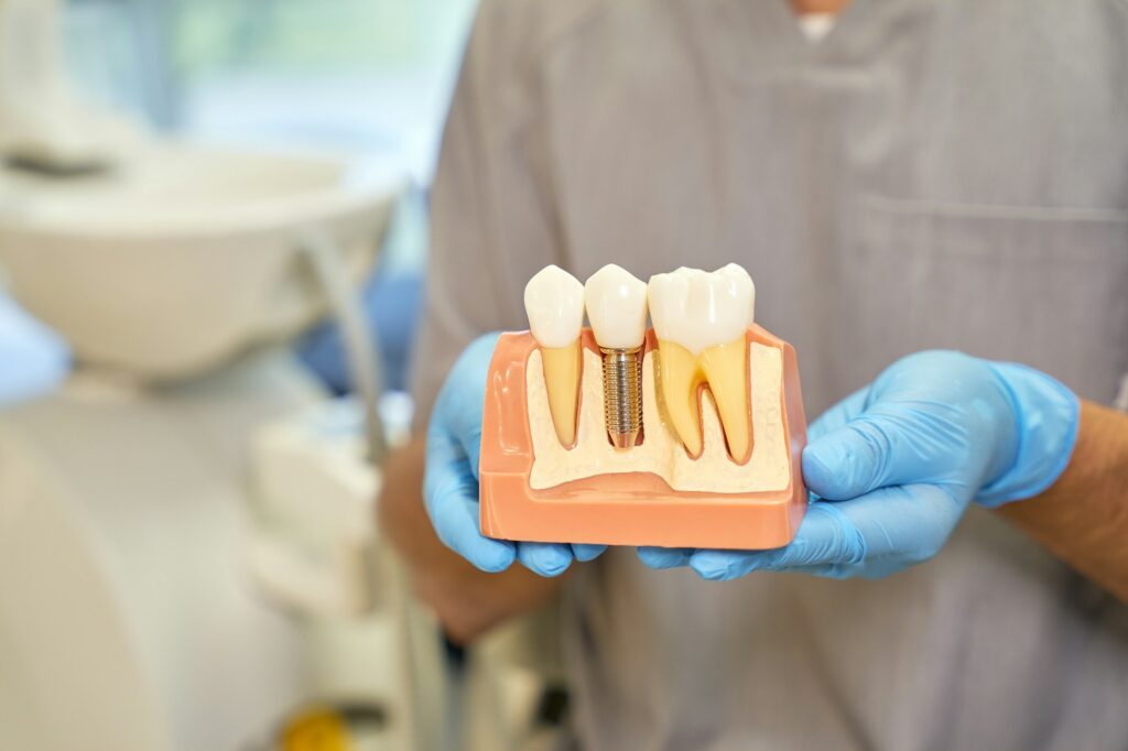 Close-up of a Derby Dental Care dentist holding a model of a dental implant, showcasing advanced restorative dental care in Derby, KS.